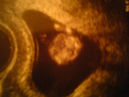 2�me rencontre avec b�b� pour l'�chographie officielle du 1er trimestre