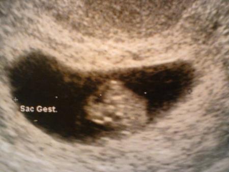 le 28 ao�t 2008 : 1�re rencontre avec b�b� chez le gyn�co avec le futur papa !!!