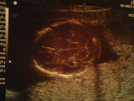 Son cerveau vu du dessus !!! C'est magique ce qu'on voit aux �chos !!!